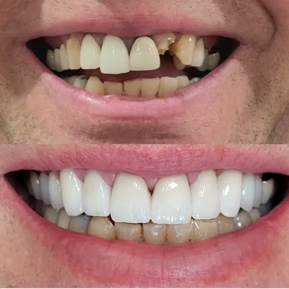 Before-and-after dental treatment, showing decayed and improved teeth.