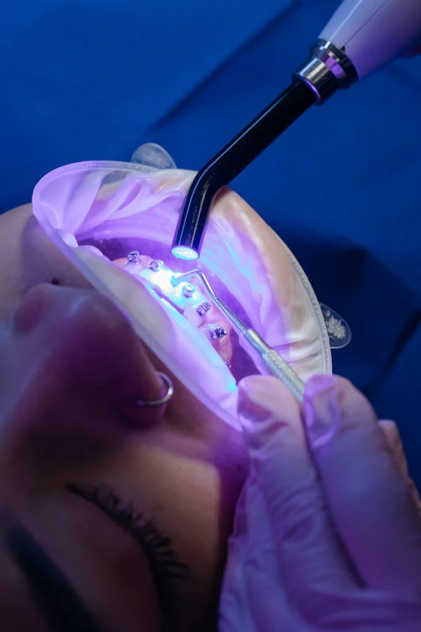 teeth whitening on teeth with braces